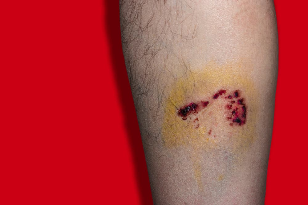 Preventing Infections from Dog Bites Tips for Avoiding Health Complications