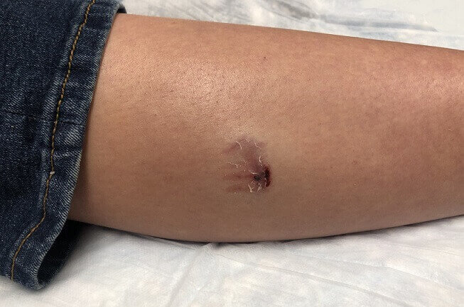 Minor dog bite injuries can be costly